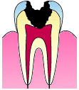 深い虫歯の進行２