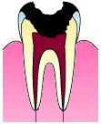深い虫歯の進行３