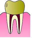 深い虫歯の進行５